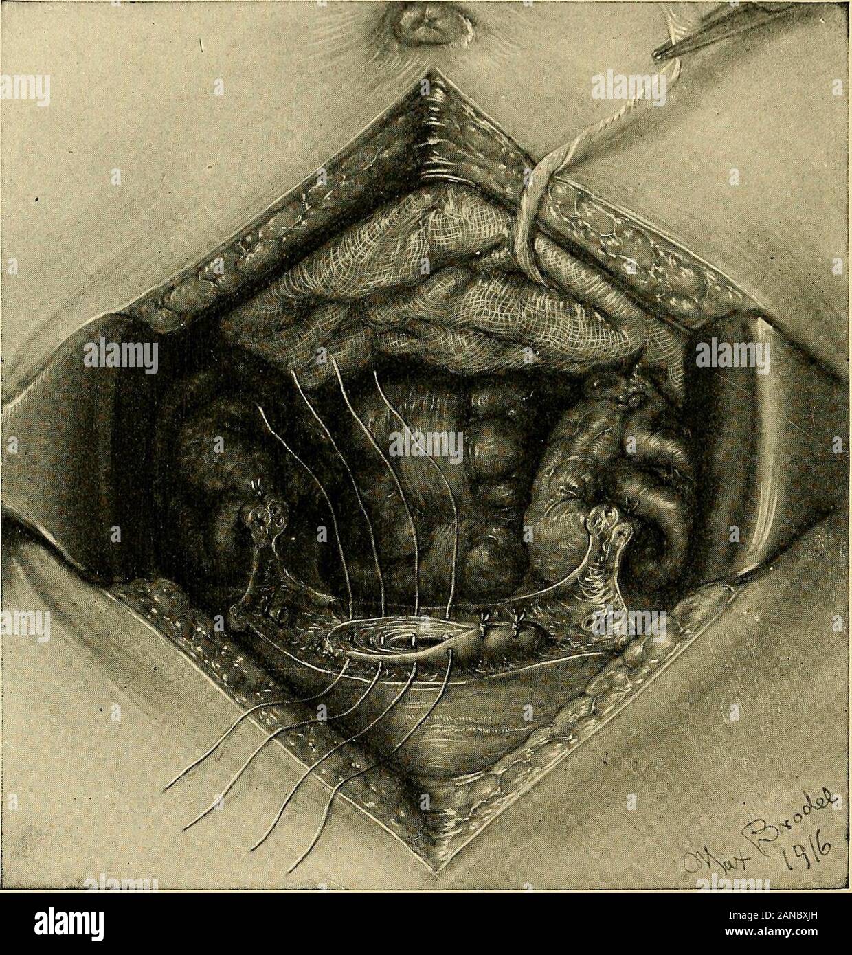 Cesarean section . Fig. 33.—Cesarean Section with Supravaginal
