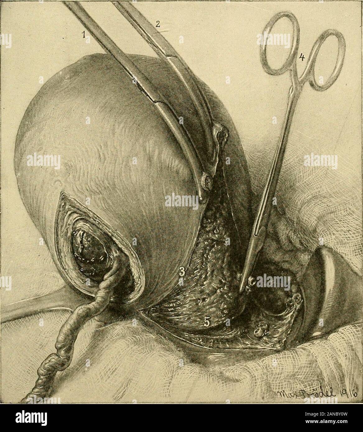 Cesarean section . l cavity, the remainder of the wound being closed bysutures in the ordinary manner. In a short time the stump and elasticligatures slough off, leaving a depressed wound, which heals by granu-lation. The operation is a simple procedure and quickly done, but owing tothe long and complicated healing process necessary and the unsightlyappearance of the resulting scar, which is deeply retracted beneath theproper level of the abdominal walls, it is rarely employed at the presenttime. Supravaginal Hysterectomy.—The Porro operation has beenpractically superseded in modern times by s Stock Photo