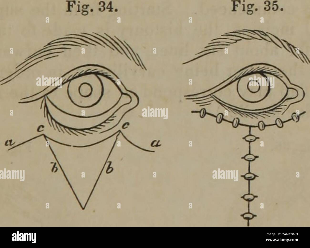 Lectures on the operations of surgery : and on diseases and accidents requiring operations . he defect! A very strong objection to this operation atonce presents itself in the fact that the incision, in healing, will con-tract, and may in consequence of this, increase the deformity. Noris the operation of Sir William Adams, the one chiefly in vogue,applicable to any other cases than those in which there exists sim-ple eversion of the lid, without much alteration in its structure,and wherever the entire organ is to be restored nothing short ofplastic surgery will prove of the least utility. The Stock Photo