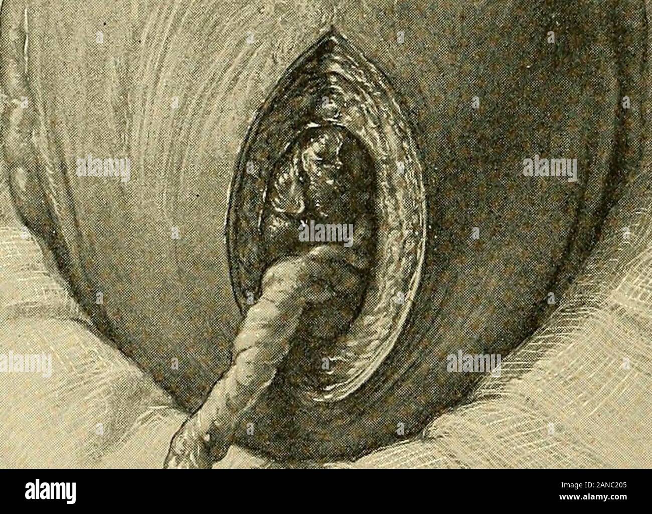 Cesarean section . Fig. 29.—Conservative Cesarean Section.Uterine