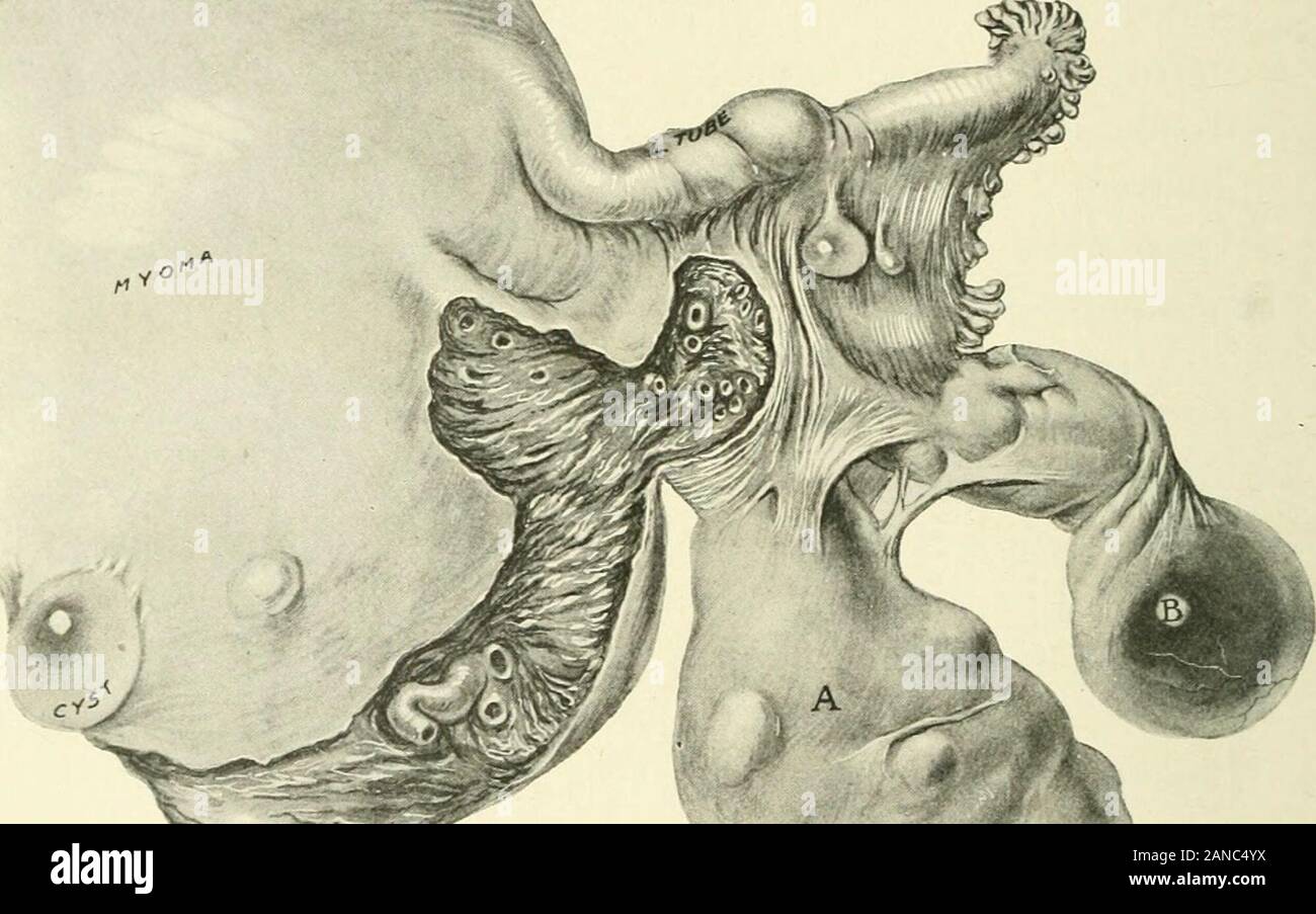 Utero ovarian ligament hi-res stock photography and images - Alamy