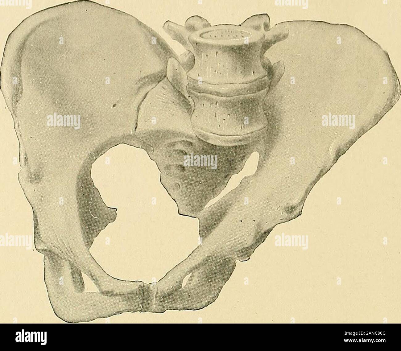 Cesarean section . g. 21.—Pelvis Obliquely Contracted from Tension of Dis-located Femur. head shows no sign of entering the pelvis, the conservative policy shouldbe abandoned and the patient delivered by the abdominal route. Obliquely Contracted, or Nagele Pelvis.—This form of contractedpelvis is of very rare occurrence, but causes serious dystocia in the ma-jority of instances, when found. The main characteristics are an obliquecontraction, involving both the brim and outlet, combined in most caseswith ankylosis of the sacro-iliac joint on the affected side. The causeof the pelvic deformity i Stock Photo