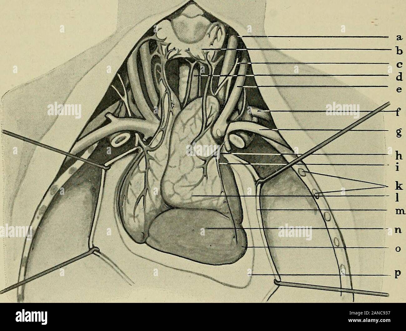 Chirurgie der Thymusdrüse . hlagstelle, weiter die Aorta ascen-dens, den Arcus aortae, greift auf die Lungenvenen über und kann hiernach Verdrängung der V. cava superior oder von links die Bifurkationder Trachea erreichen, sich sogar zwischen Trachea und Ösophagus ein- 30 Deskriptive und topographische Anatomie der Thymusdrüse. schieben. Sie folgt weiter der schräg nach rechts absteigenden V. ano-nyma sinistra. Mit dieser ist sie besonders fest verwachsen. Rechts trittsie nach der V. cava superior mit der V. anonyma dextra in Berührung.Oberhalb der V. anonyma sinistra liegt sie unmittelbar auf Stock Photo