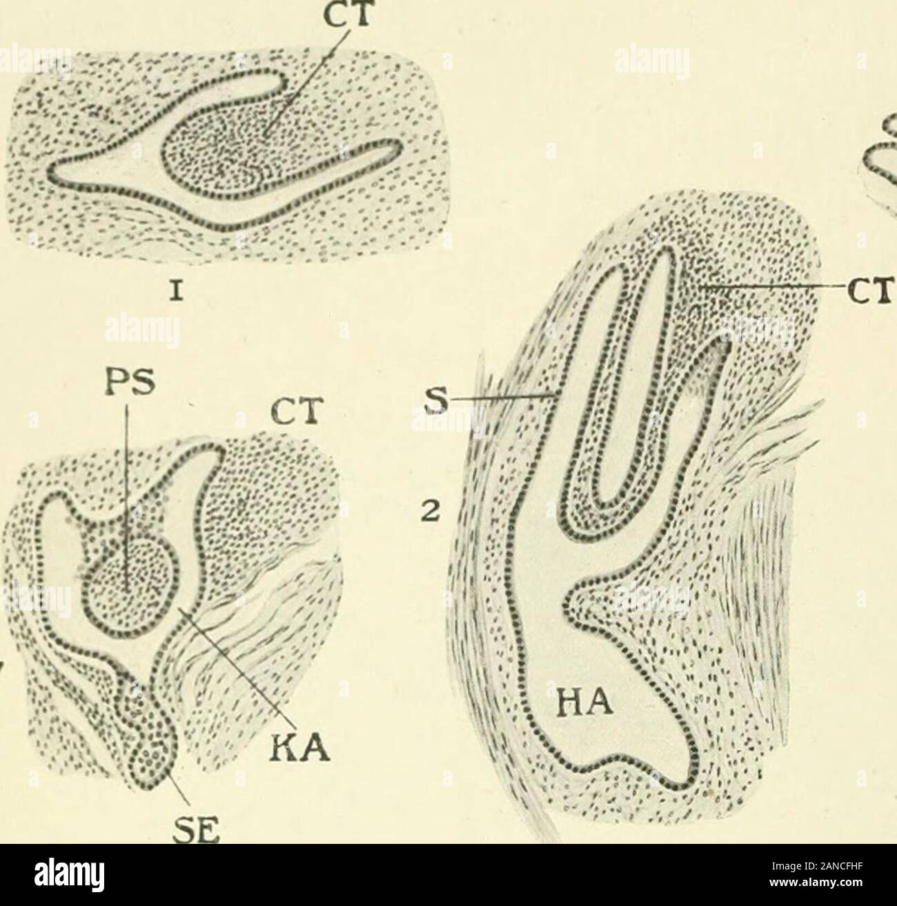 Fibroids and allied tumours (myoma and adenomyoma) : their pathology, clinical features and surgical treatment . Fig. 170.—Showing pigment-bodies within the gland-tubules of an adenomyoma. (FromF. V. Recklinghausens monograph, Die Adenomvome und Cystadenome des Uterus,Taf. xi. Fig. i, Case xvi. Adenomyoma of the right tubal angle and hydrosalpinx.From a patient who died of syphilitic pachymeningitis and leptomeningitis cerebralis.) a = dilated glands ; ^=:pigment-bodies j w = muscle. dipping for 10, 15, 30 mm. into the growth. There wereno peritoneal adhesions. Two years later, at a meeting of Stock Photo