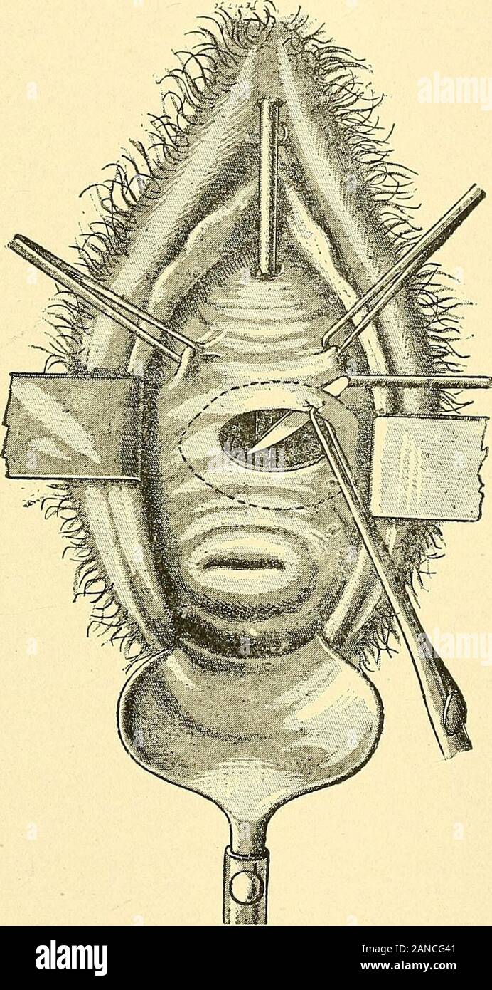 Treatise on gynaecology : medical and surgical . t;Straight, convex, and bent bistouries; 4, spatula; 5, 6, blunt and pointed hooks; 7, 8, Coghills wiretwister, and Denouvilliers S-shaped wire twister; 0, Collins spring forceps. The fourchette should be depressed by a short and broad-bladedSimons speculum; a retractor can be nsed to elevate the anteriorvaginal wall if necessary; a metallic sound introduced into the blad-der may be used to bring the base toward the operator; finally, thecervix is fixed and brought down by Museux forceps. Second Stage.— Vimfying the Lips of the Fistula.—For this Stock Photo