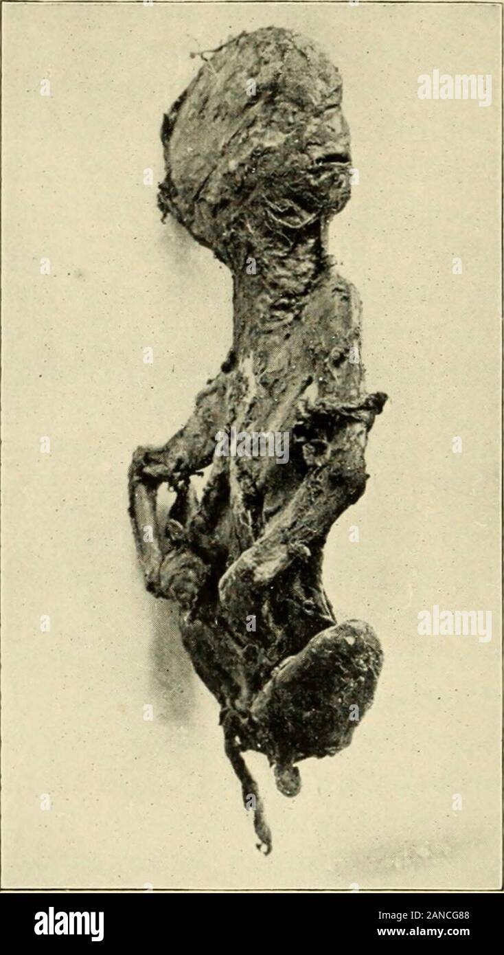 A Textbook Of Obstetrics N As Acardia But In The Early Stages Ofdevelopment Each Placenta Even In Unioval Twins Isseparate When The Em Bryos Are Derived Each Froma Separate Ovum Thereshould Be Separate Decidualreflexae