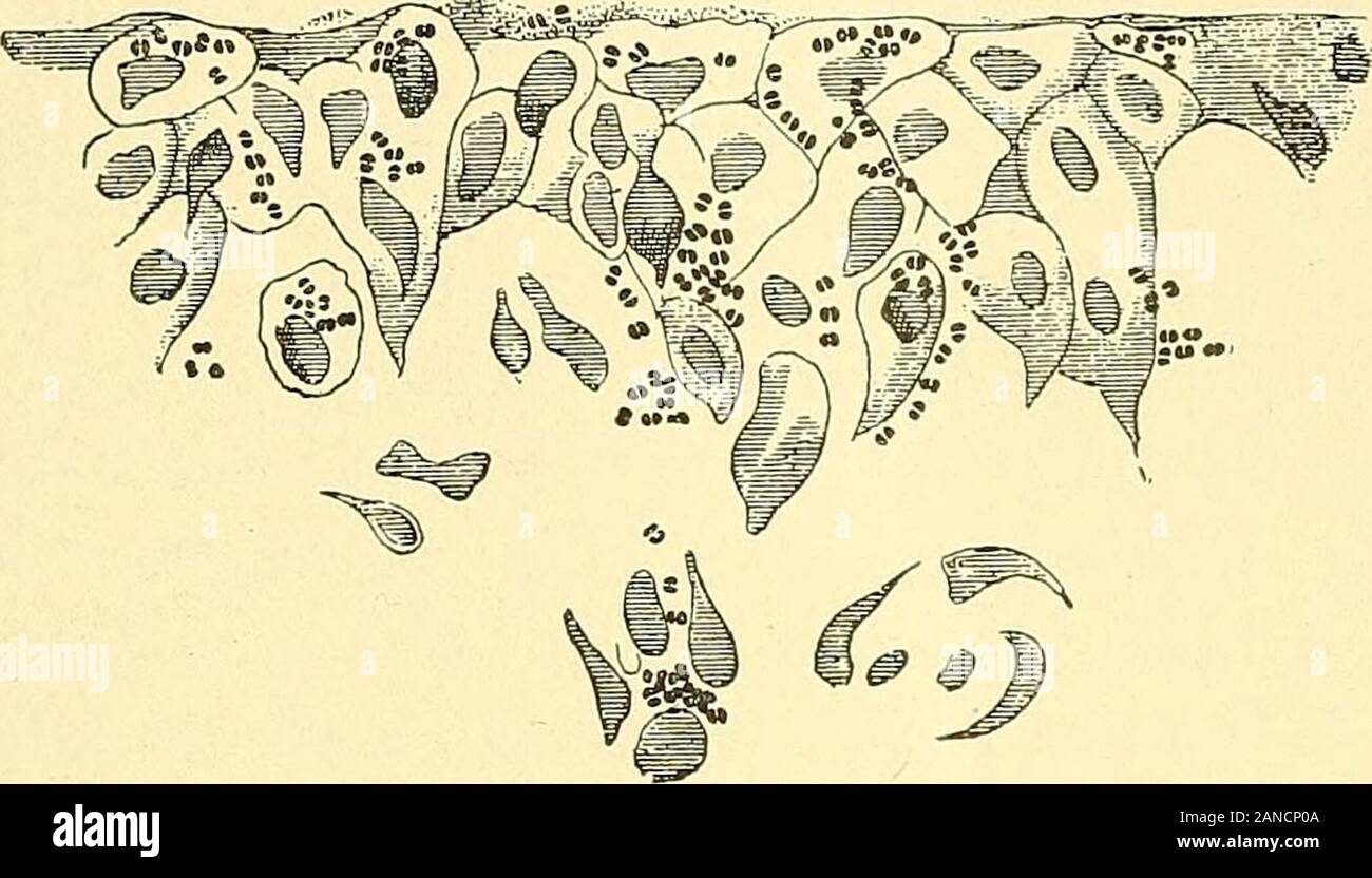 Treatise on gynaecology : medical and surgical . l-oi^ment of the microbes. These considerations indicate the patho-genesis of vaginitis, and ex^Dlain the predisposing influences of men-struation and jparturition, as these favor the stagnation and decom-position of secretions. Gonorrhoeal infection is of supreme importance in the etiology ofvaginitis, on accou^nt of the persistent character of the inflammation DISEASES OF THE VAaiNA. 273 caused, and tlie gravity of its complications. Since the discovery ofISeisser,^ tlie germ of this affection has been considered a speciiiccoccus called the go Stock Photo