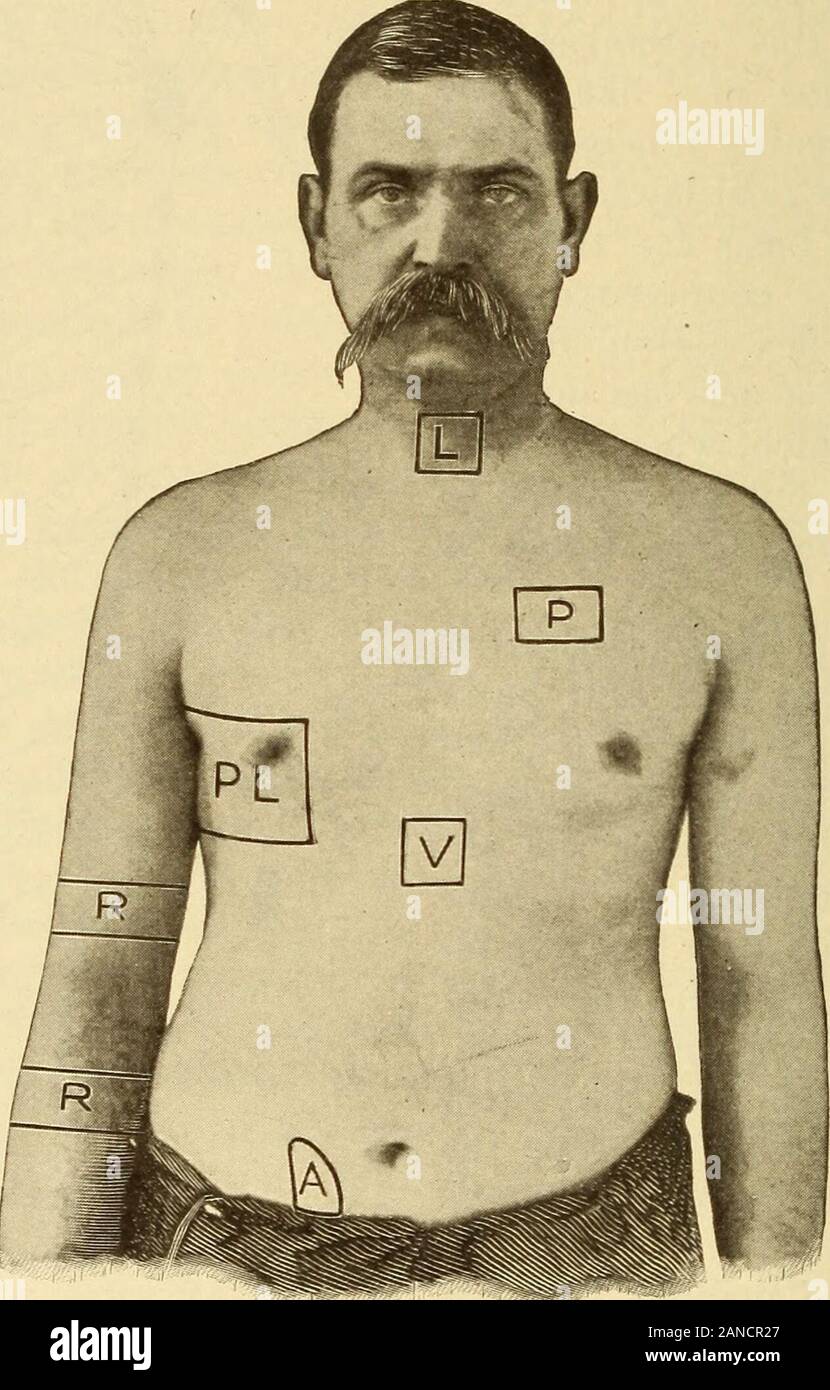 A text-book of practical therapeutics . n solid lines.The arrows indicate the normal direc-tion of the nerve impulses or nerveconduction. S.c, superior cervicalganglion; I.e., inferior cervical gang-lion; T, the first thoracic ganglion; Sp.,the splanchnic nerve; C, the semilunaror celiac ganglion; m, the inferior mesen-teric ganglion; h, the hypogastric nerves;N. E., the nervus erigens. The num-erals indicate the corresponding spinalnerves. (Howells Physiology.) 578 REMEDIAL MEASURES OTHER THAN DRUGS area, but a little to one side of it, or at a spot known to be connectedintimately with the di Stock Photo