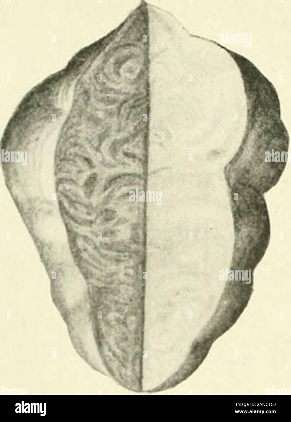 Fibroids and allied tumours (myoma and adenomyoma) : their pathology, clinical features and surgical treatment . Figs. 157 and 158.—Showing pedunculated cervical submucous myomas ((ibroid polypi). ..1^?^^^ ^ X. Stock Photo