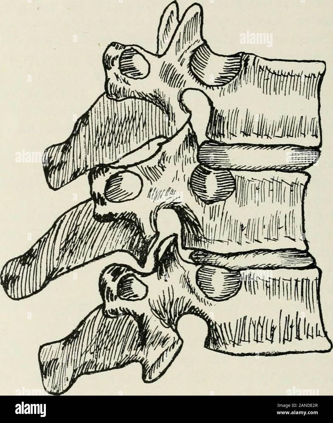 Principles and practice of spinal adjustment; for the use of students and practitioners . sent, such destructive changes occur inthe intervertebral disc that a compression subluxation nearlyalways accompanies it. Posterior subluxations occur more frequently in thethoracic than in the cervical or lumbar regions of the spine.This is due to the natural backward curvature of the vertebralcolumn in this section. These subluxations are usually aresult of an injury, or are produced by occupations whichrequire a constant stooping position. The intervertebral foramen is diminished in size antero-poster Stock Photo