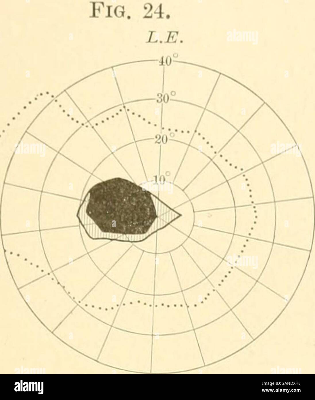 tobacco amblyopia The toxic amblyopias: their classification, history, symptoms, pathology,  and treatment . Sometimes there are islands of absolute defect within  therelative scotoma. I have described several typical casesof this  character. (Fig. 21; also