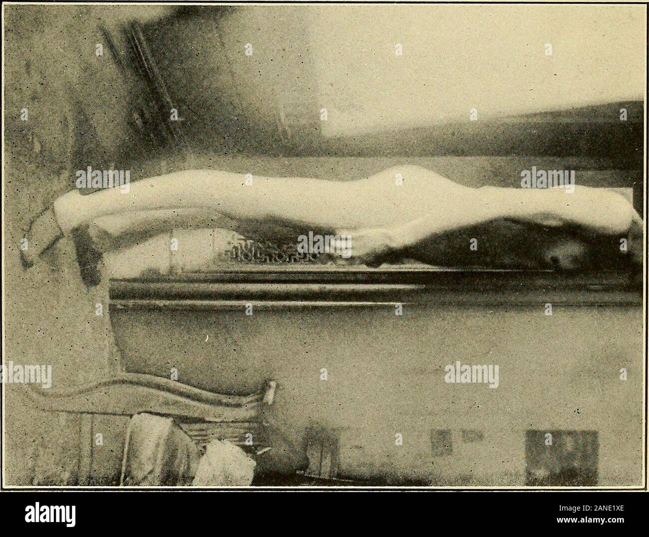 Tabes dorsalis hires stock photography and images Alamy