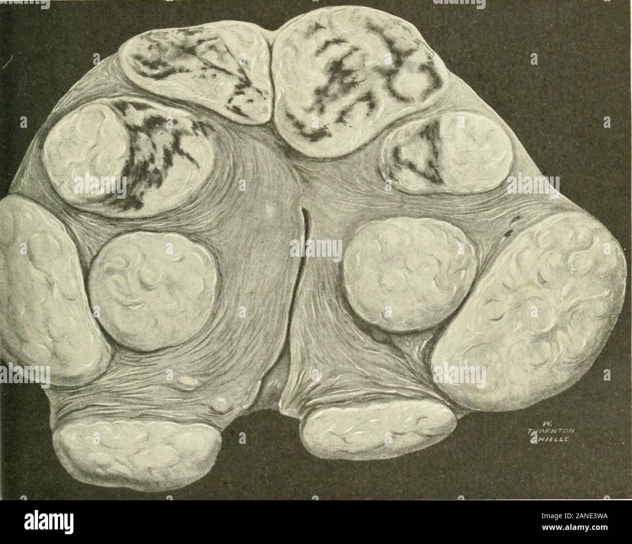 Fibroids and allied tumours (myoma and adenomyoma) : their pathology, clinical features and surgical treatment . Figure 92. Same section as seen above, showing small endotheliallymph-spaces in hyaline areas (X 4). F.ACE I-AGE 79 INFECTION 79 to show as four) show dark areas of telangiectatic change. Figu re 91, Plate XXIV., shows a telangiectatic condition associated with a lymphangiectatic development in a myoma. In Figure 92, Plate XXIV., is seen the microscopic slide (magnified four times) from which Figure 91 was drawn ; it. Fig. 9c.—Showing telangiectatic areas in myomas. The colour has b Stock Photo