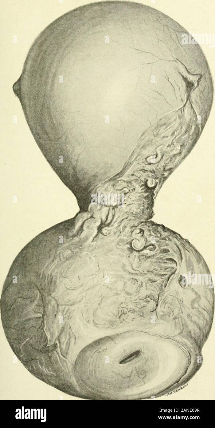 Fibroids and allied tumours (myoma and adenomyoma) : their pathology, clinical features and surgical treatment . FuiURE 76. Showing large fat-globules lying in columns correspondingto the original direction of the muscle-bundles.-^ in. obj. ^ eyepiece.The section was taken from the cervical myoma seen in figure 75, plate XVII. .&gt;;/&gt;-v y. Figure 77. Showing fatty globules within fragments of muscle-hbres.The nuclei of the cells still persist. -i in. obj. 2 eyepiece. The section was taken from the cervical myoma seen in figure7^. Figures 76 and 77 were stained with Sudan III.. Fig. 78.—Sho Stock Photo