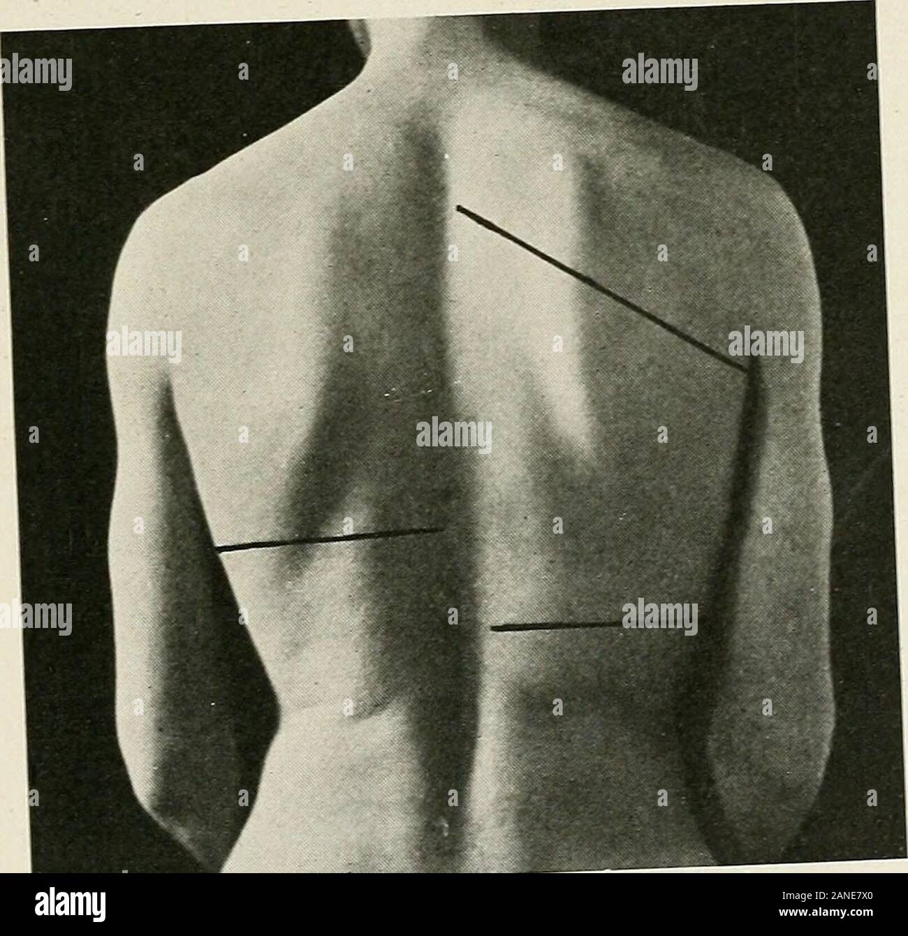Diseases of the chest and the principles of physical diagnosis . Fig. 339.-Showin, area .kodaic tympany (Garlands triangle).. r,^. 340.-Upper and lower Umits of dulness in a massive effusion. In massive effusions the highest point of cMness^^^^^^^spine (see Fig. 340) and ^^^^fZ^^J^^^^^^ character but lapsed portion of the lung the ^^^^^^^^J^^^^^^^ devoid of air the if?the king has been so completely compiesseci as lo je 584 DISEASES OF THE BRONCHI, LUNGS, PLEURA, AND DIAPHRAG.M note will be dull. In massive effusions the flat or dull percussion noteanteriorly may be elicited some distance to t Stock Photo
