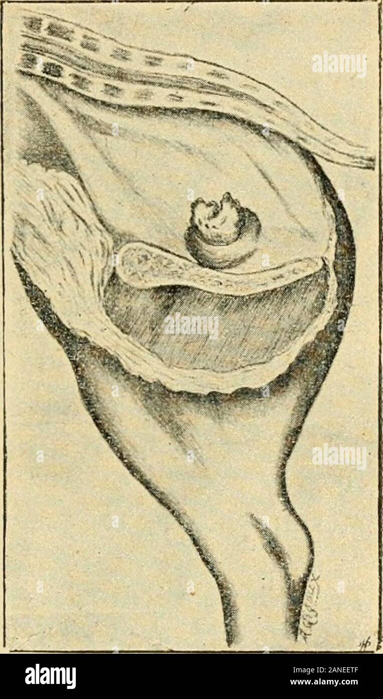 SÃ©miologie et diagnostic des maladies des animaux domestiques . ¨res, appelÃ©es encore pseudo-rhumatismales, sont Ã©gale-ment des arthrites infectieuses (fi. 107). TENDONS. 377 Larthrite pyokÃ©mique des Jeunes animaux est frÃ©quem-ment liÃ©e ;i une phlÃ©bite du cordon omijilical (1) quiest Ã©galement lexpressiondune inf^^ction par cellevoie (Morot) (fig. i08). Ces diverses formes dar-Ihrites peuvent aboutir Ã lusure des cartilages diar-tbroliaux,dla productioniVostÃ©ophytcs et Ã la dÃ©lbr-mation des surfaces aiti-culaires. Celte afTeclion,niononrticulaire ou poly-arliculiire poite le nomdarth Stock Photo