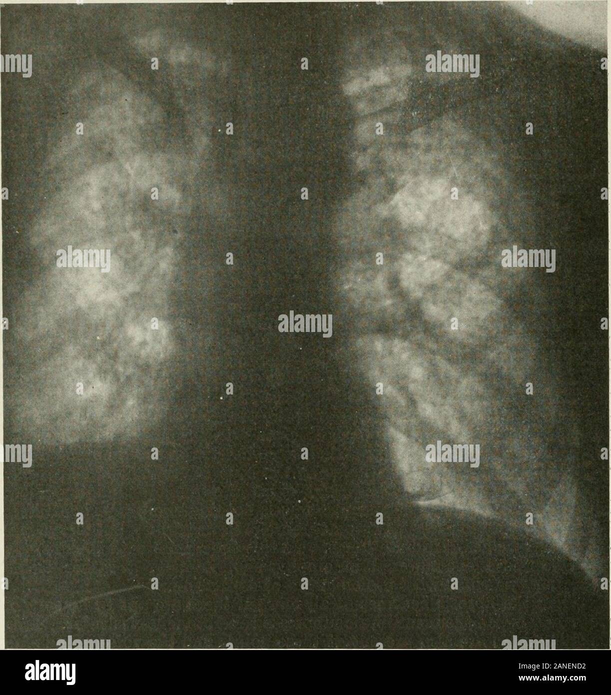 Rales hi-res stock photography and images - Alamy