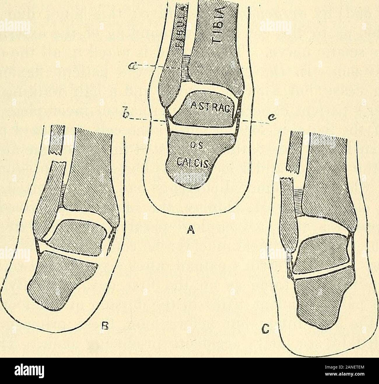 A practical treatise on fractures and dislocations . g lost its