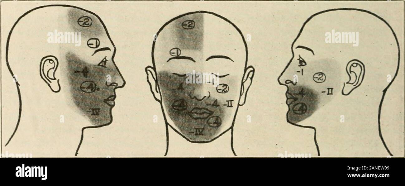 AMAarchives of neurology & psychiatry . Fig. 1 (Case 12).—Oct. 16, 1920