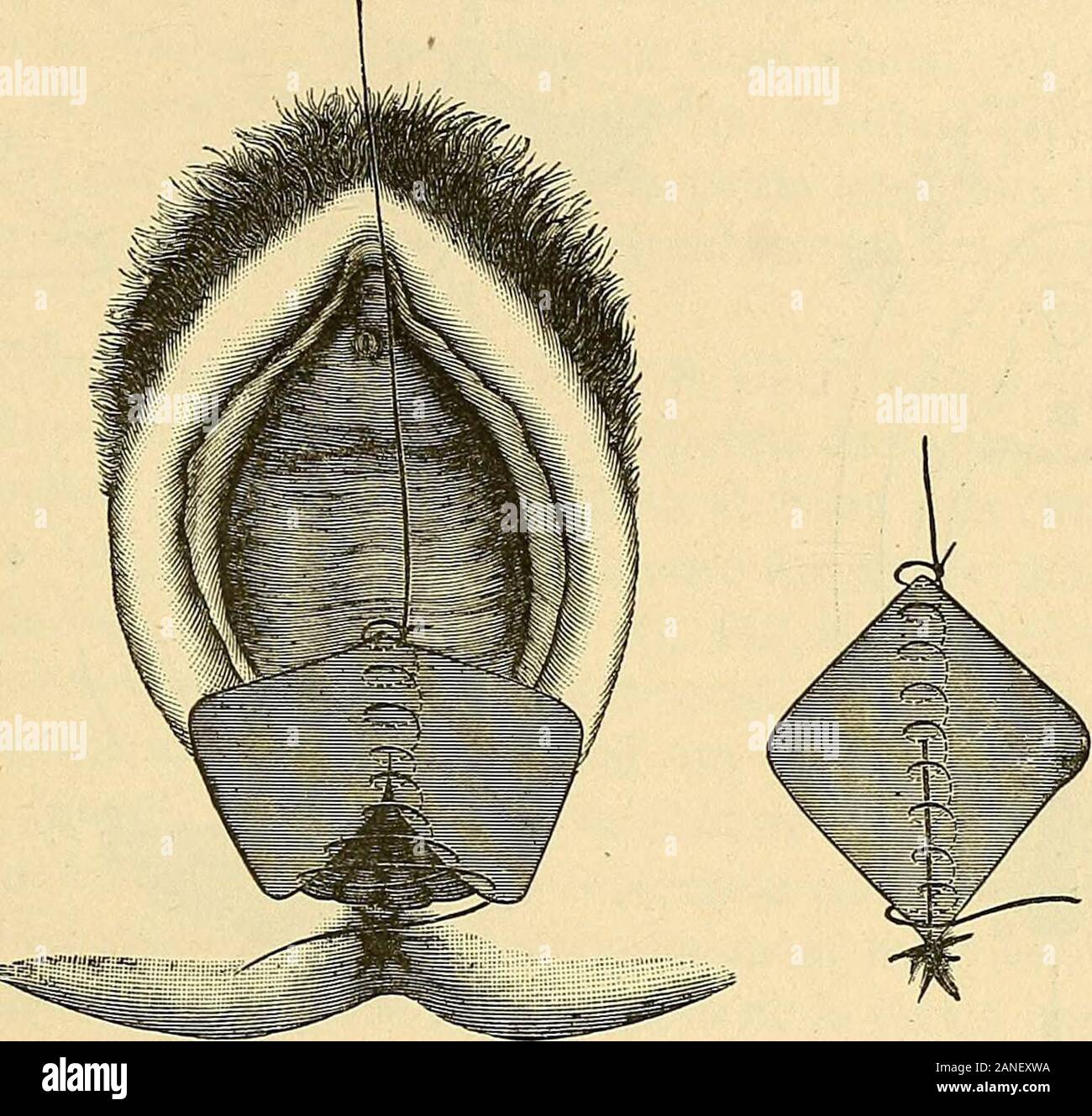 Traité de gynécologie clinique et opératoire . Fig. 438. — Déchirure complète du périnée. Suture