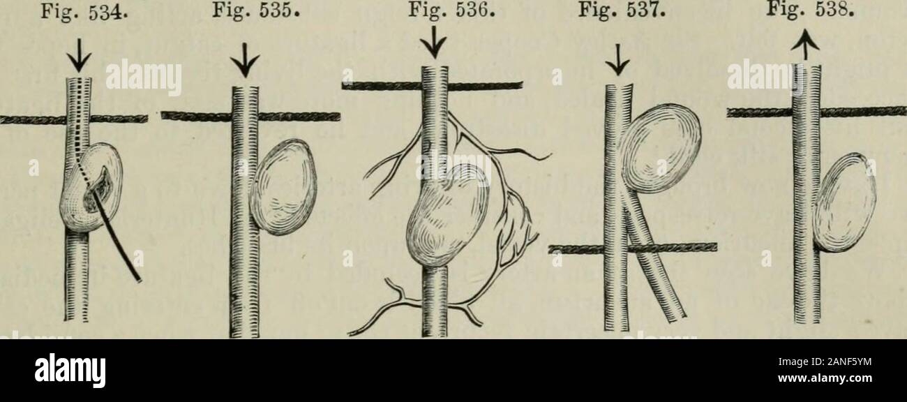 The International Encyclopaedia Of Surgery A Systematic Treatise On The Theory And Practice Of Surgery Rs Have Not Been Able To Appreciate That Great Surgeon Desault Who At That Time Was Aware