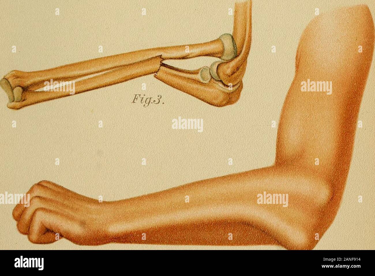 Atlas and epitome of traumatic fractures and dislocations . Iig.l.. Fig