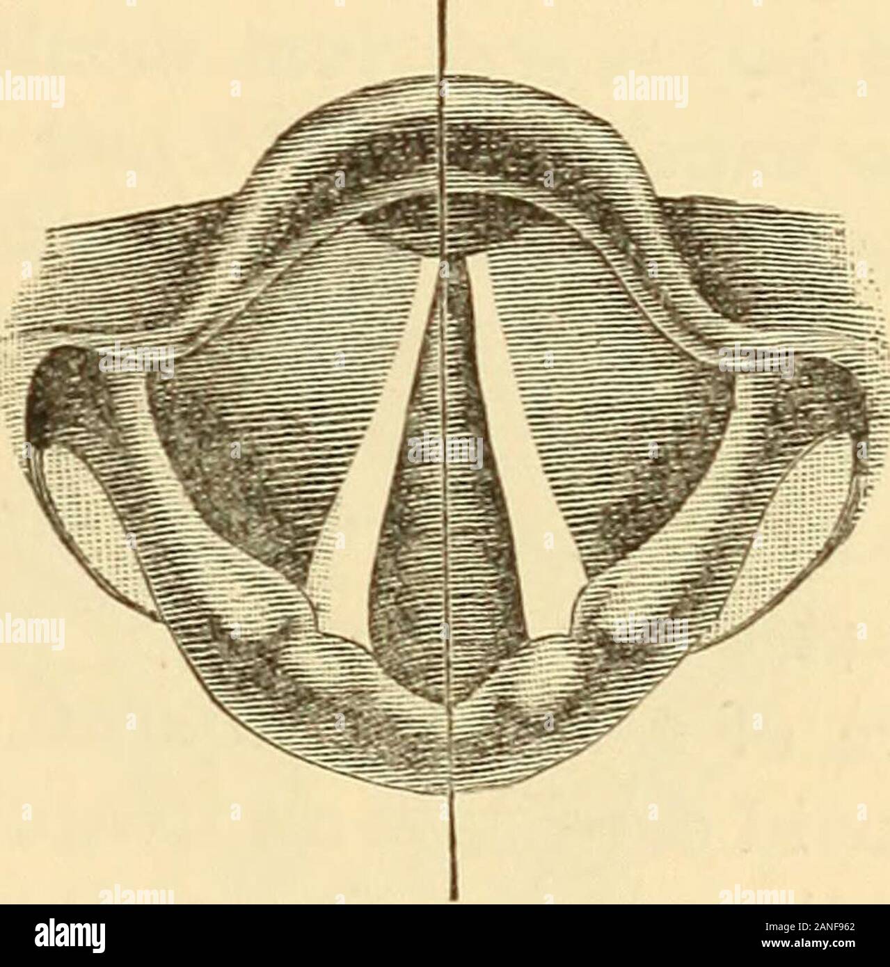 A text-book on diseases of the ear, nose and throat . Right recurrent paralysis; i)osition of Bilateral recurrent laryngeal paralysis, cords in deep inspiration. Black perpen- (Porcher.) dicular indicates median line of rimaglottidi&gt;. (Porcher.) Symptoms.—If the paralysis be confined to one side, the voice becomesat first weak and later hoarse, vocal range is limited, and conversationfatiguing. The affected cord is generally in the so-called cadavericposition,—that is, midway between adduction and abduction,—with con-cave edges. After a while the sound cord crosses the median li?ie tomeet i Stock Photo