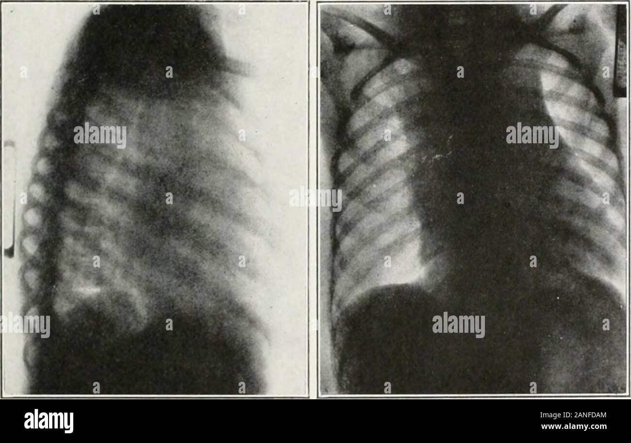 Tracheal stenosis hires stock photography and images Alamy