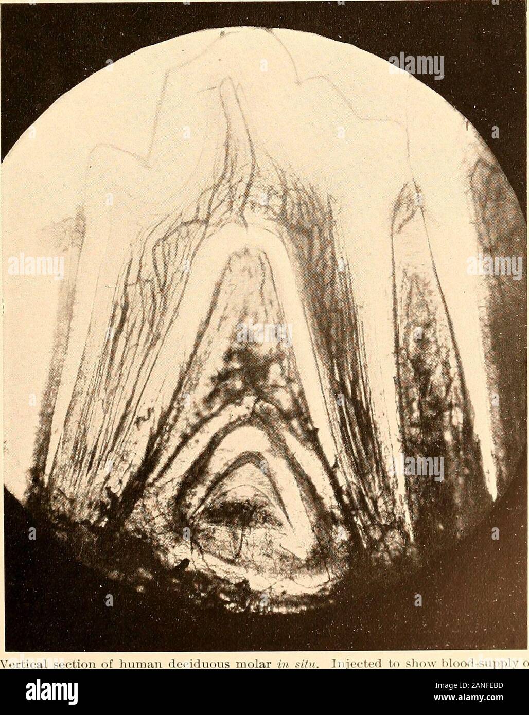 Principles and practice of operative dentistry . 185.—Injected Wood