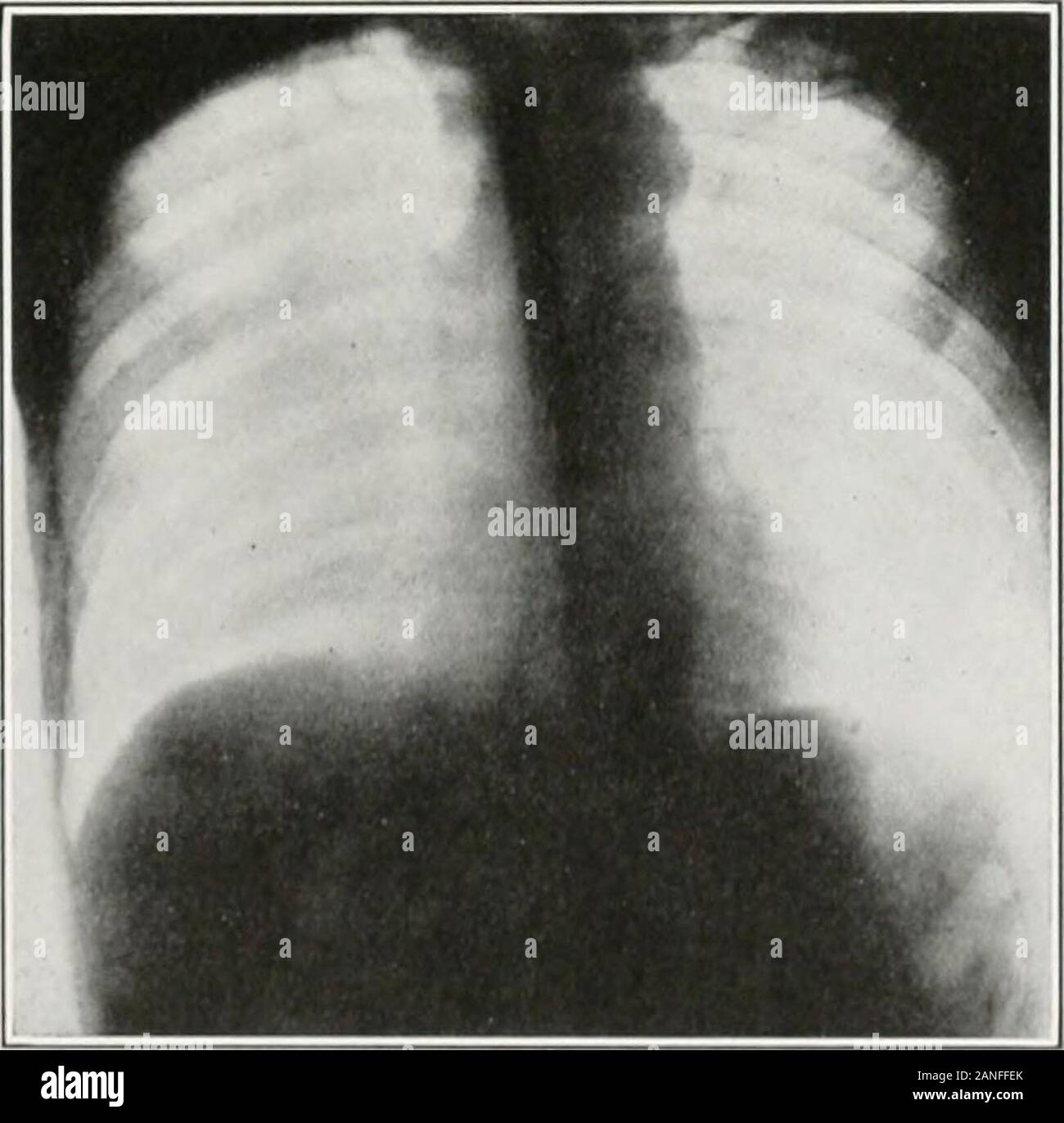 Endoscopy normal esophagus hires stock photography and images Alamy