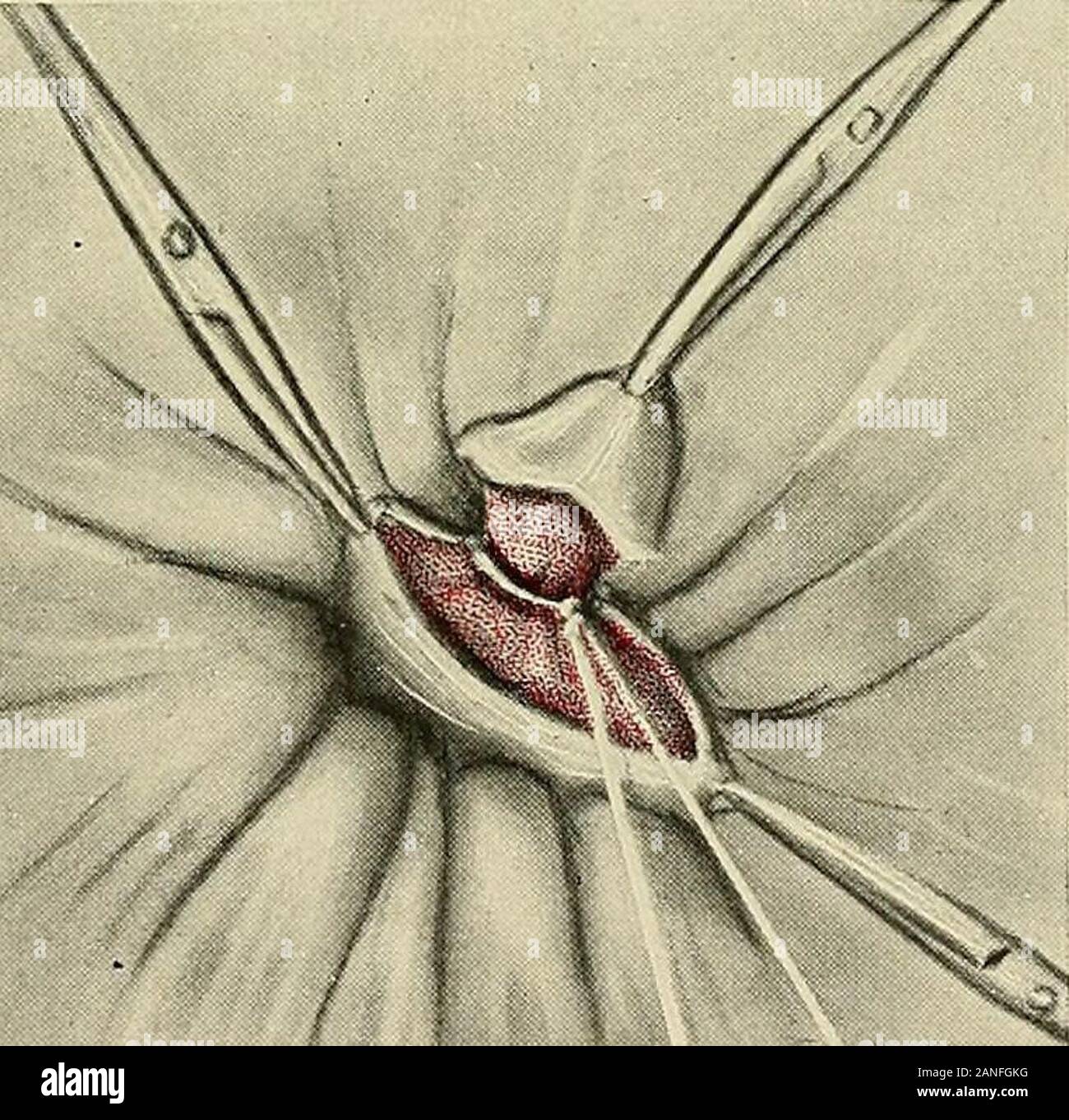 Gynecology . YllP.Gr- Fig. 414.—Ligation of Hemorrhoids.The hemorrhoid has  been grasped and brought to view by fine pressure forceps. The hemorrhoid  is dissected by knife or scissors. sutures that approximate the skin