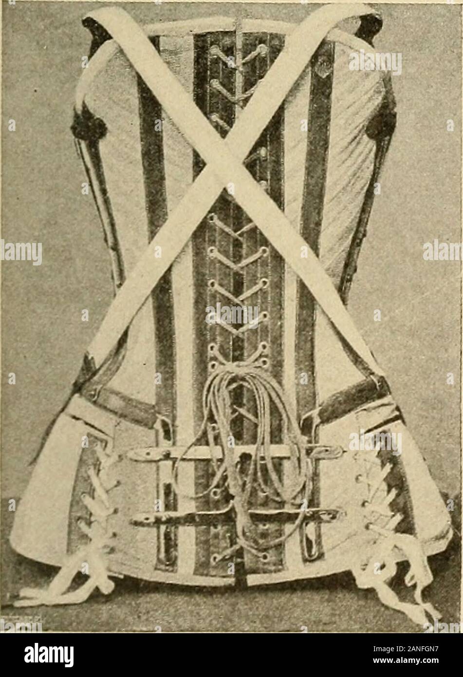 Lateral curvature of the spine and round shoulders . Fig. 124.—Brace for Scoliosis, Pig. 125.—Brace for Scoliosis, Back.—(Z. B. Adams.) Front.—(Z. B. Adams.). Stock Photo