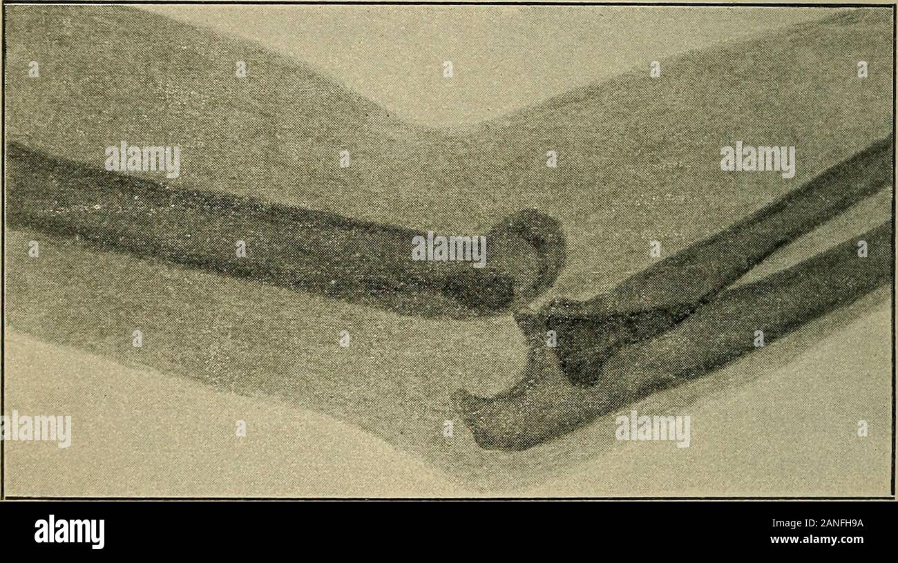 Atlas and epitome of traumatic fractures and dislocations . Fig. 81.—Eecent backward dislo-cation of the left forearm in a boyfourteen years of age (Kriiger, 1896).Swelling, prominence of the olecra-non, shortening of the forearm areseen. The dislocation was reducedand perfect recovery ensued. 188 FRACTURES AND DISLOCATIONS. cadaver. The arm need only be overextended to producea tear in the anterior segment of the articular capsule ; theolecranon during this movement is braced against the pos-terior supratrochlear fossa, and after the bones have beensufficiently forced apart, the forearm is su Stock Photo
