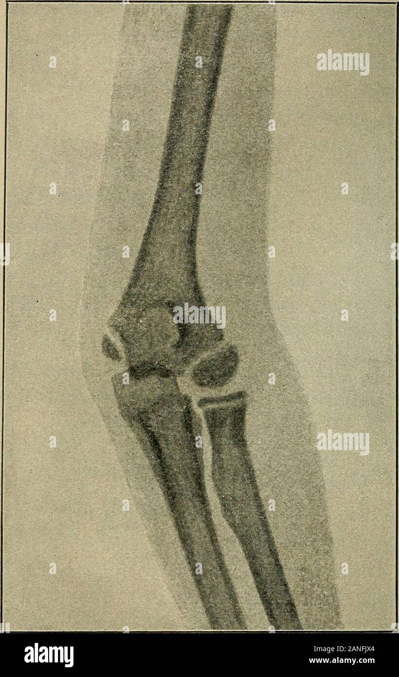 Atlas and epitome of traumatic fractures and dislocations . he lower ...