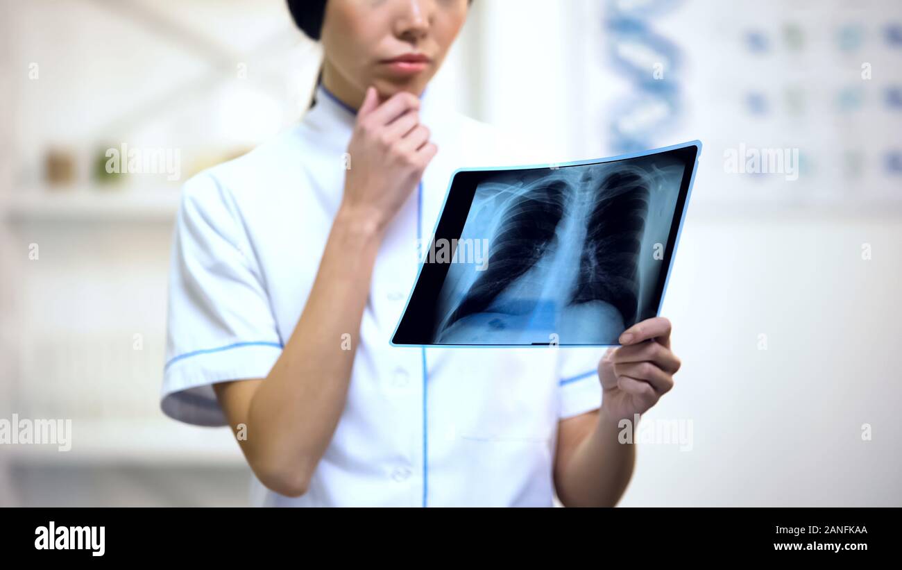 Tb chest x ray hi-res stock photography and images - Alamy