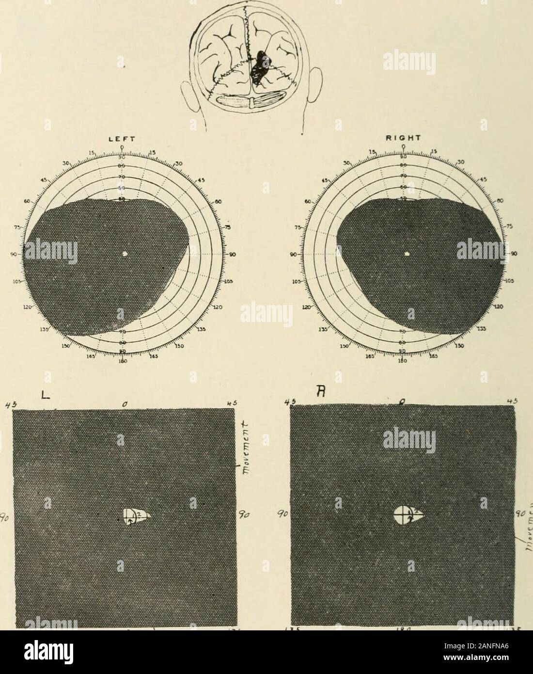 AMAarchives of neurology & psychiatry . Fig. 9 (Case 9. L. S.).—Left