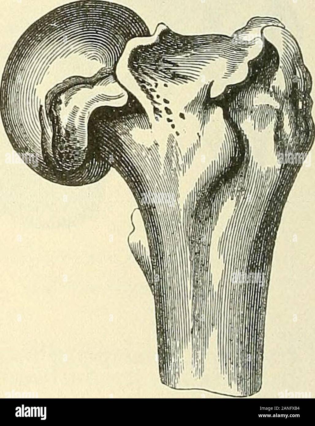 Intracapsular Intracapsular Fracture High Resolution Stock Photography and Images - Alamy