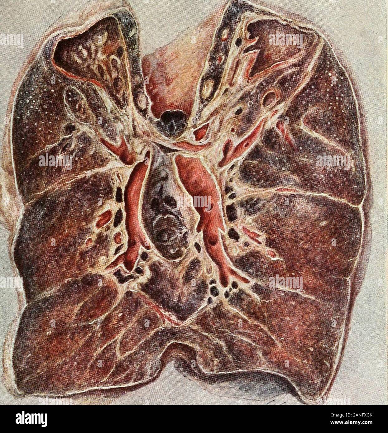 Febrile condition hires stock photography and images Alamy