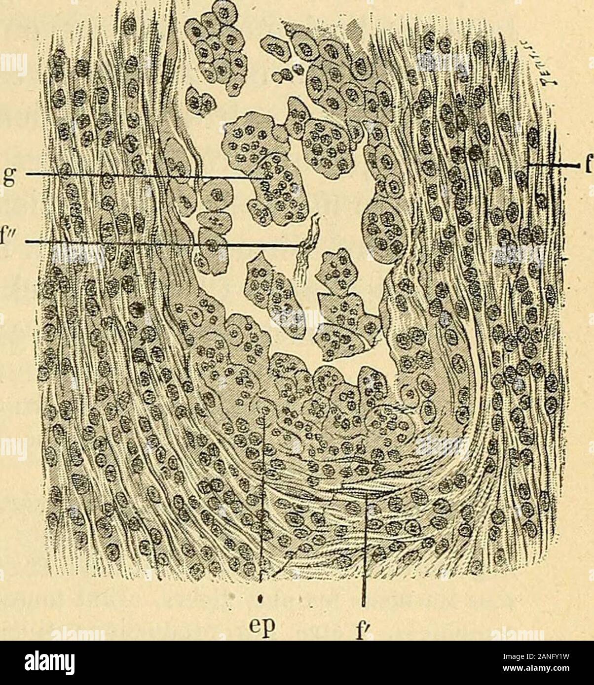 Traité de gynécologie clinique et opératoire . ^W. D Fig. 571. — Endothéliome de lovaire (Pomorski).C. Stratification en couches parallèles du tissu conjonctif, début de la formation des alvéoles. (Même grossissement.)p. Alignement en chapelet des cellules, f, f . Cellules fusiformes, vestige du tissu conjonctif fibril-laire. e.p. Transformation directe des cellules tuméfiées en cellules épithélioïdes. e.Cellulerésultant de la prolifération située entre les cellules épithélioïdes et non encore complète-ment transformée, a. Stratification commençante du tissu conjonctif, sous linfluence de lapr Stock Photo