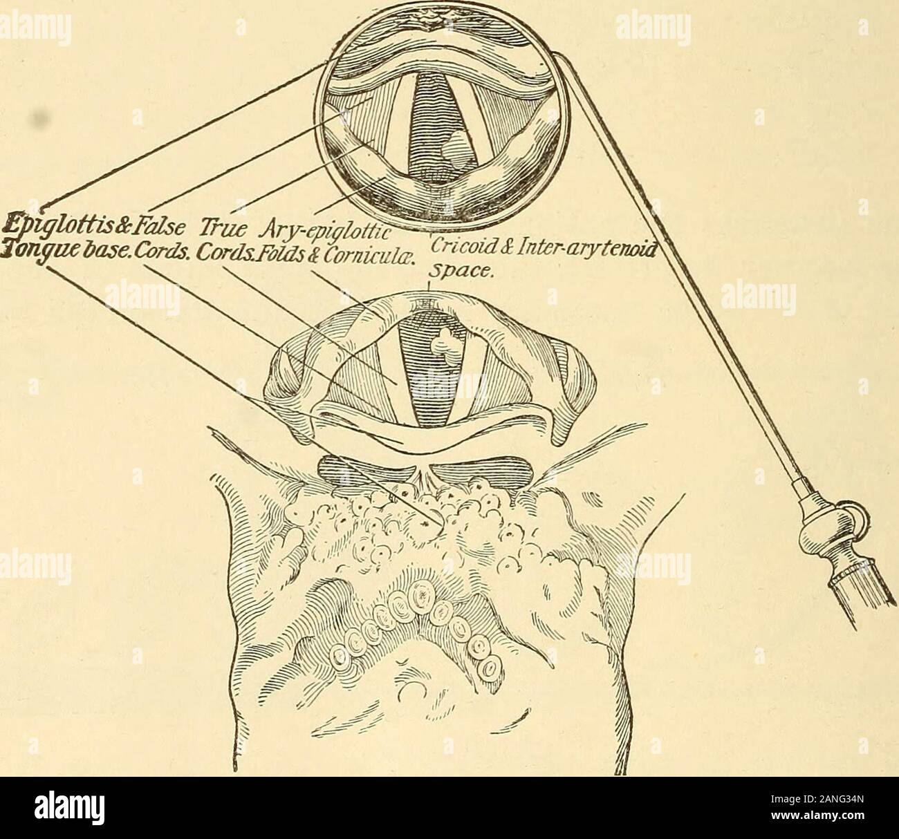 A Text Book On Diseases Of The Ear Nose And Throat Diagram Showing The Principle Of Laryngoscopy Bosworth Fig 242 Diagrammatic View Of Tongue Base Epiglottis Arytenoids And Aryegiglottic Folds Ventricular Bands Andvocal Cords