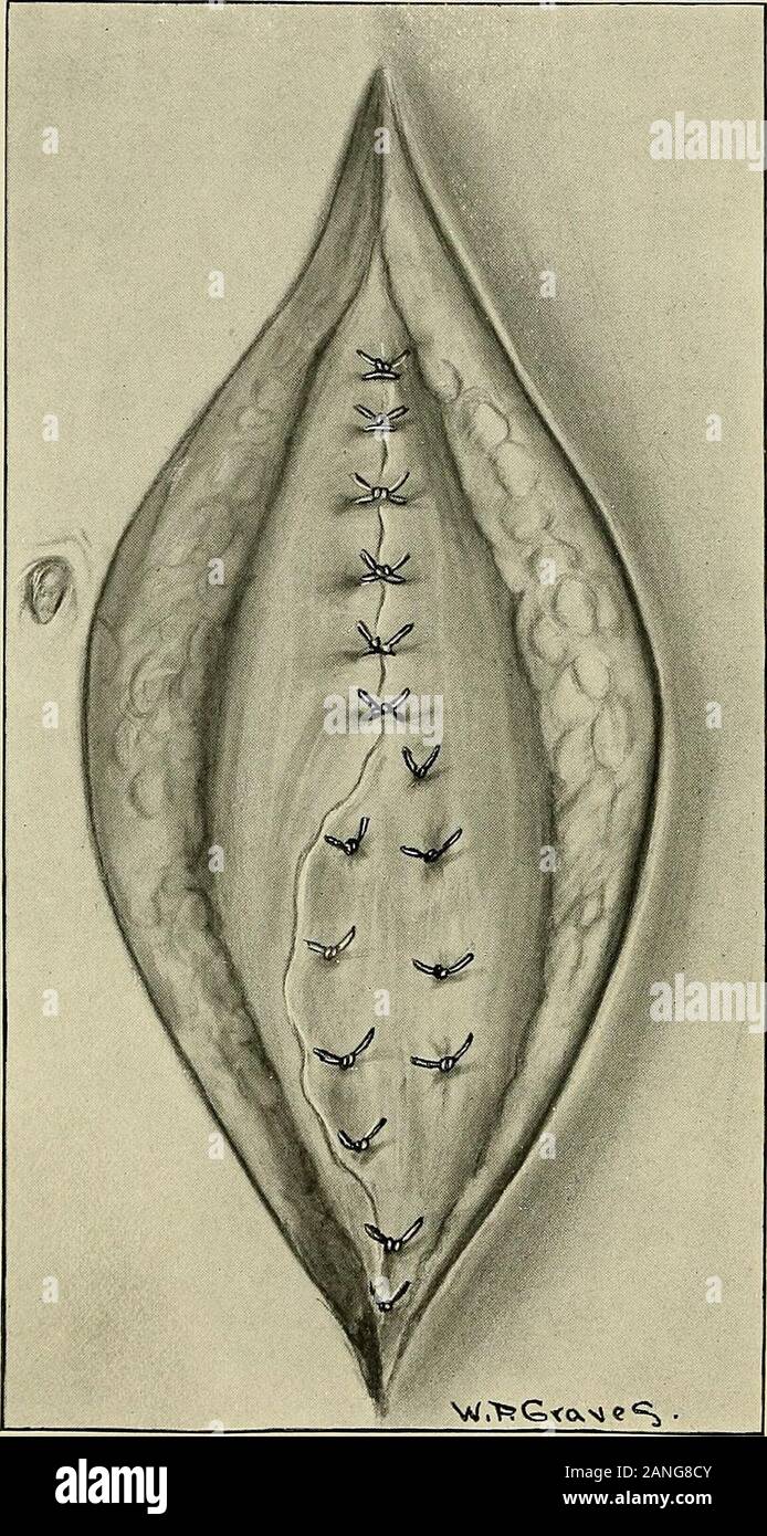 Gynecology . Umbilical Hernia.The hernial sac has been dissected away from  the surrounding abdominal fat and lifted up fromthe fascia. The sac is  being cut away at the hernial ring. If the