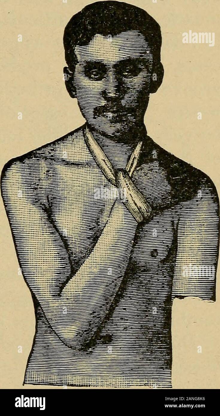 Atlas and epitome of traumatic fractures and dislocations . URES OF THE