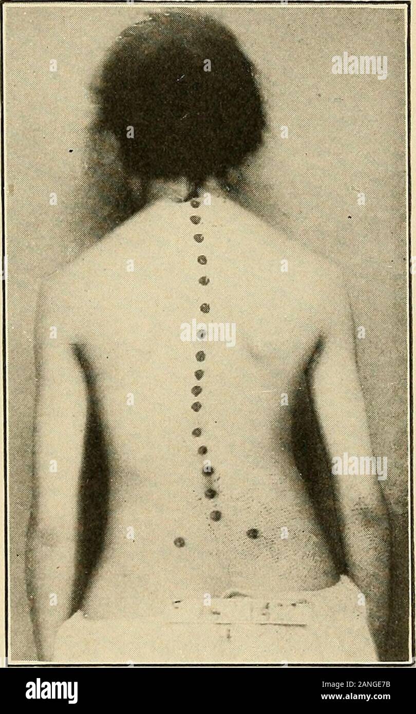 Lateral curvature of the spine and round shoulders . FiG. 74.—Scoliosis Due to Asym-metry OF THE Pelvis, the RightSide Being Smaller. Fig. 75.—Left Lumbar ScoliosisFROM Inequality IN the Length ofLegs. sional experience to find that the spinal curve is increased byputting a block under the foot on the side shown to be short bymeasurement, and that the spinal curve is thus improved by mak-ing the long leg longer. (d) Unequal hearing causes a tilting or twisting of the head whichmay produce a temporary lateral curve in the cervical and upperdorsal regions. I04 ETIOLOGY (e) Unequal vision, necess Stock Photo