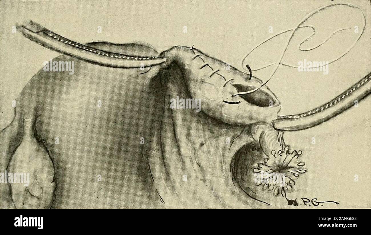 Ovarian suspensory ligament hi-res stock photography and images - Alamy