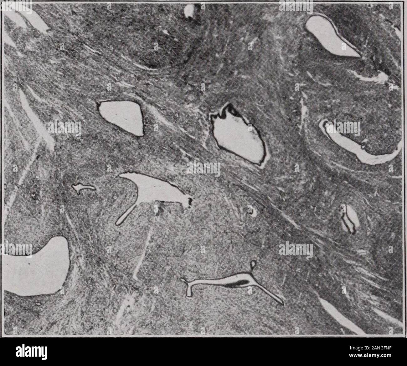Transactions of the American Association of Obstetricians, Gynecologists, and Abdominal Surgeons for the year ... . Fig. 3.-—Cross section of submucous adenomyoma showing the muscular stroma perforatedby countless numbers of slightly dilated glands. Large cystic cavities are seen along the innerand lower portion of the picture. The intracanalicular portions can be made out in severalplaces. instances these glands are surrounded by an endometrium-like stroma.The involved portion of the uterine wall at the site of the former at-tachment of the tumor has the same structure which is characteristic Stock Photo