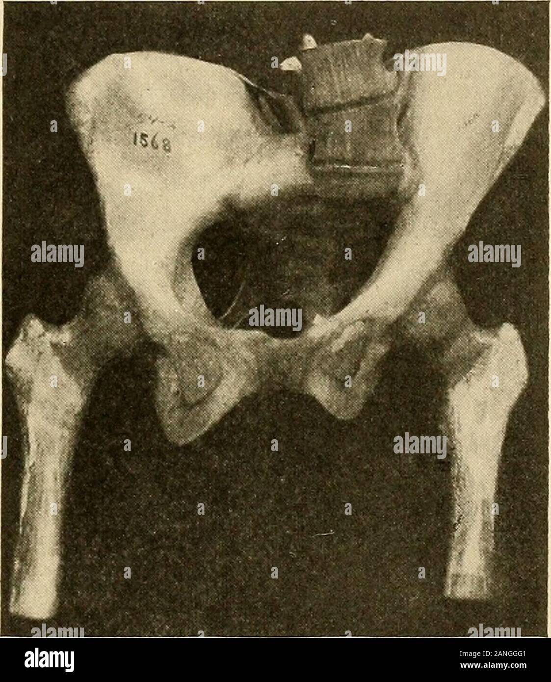 Lateral curvature of the spine and round shoulders . will sometimesshow a  slight tendency to curve to the right in the dorsal region, which  FUNCTIONAL SCOLIOSIS. SI may be due to