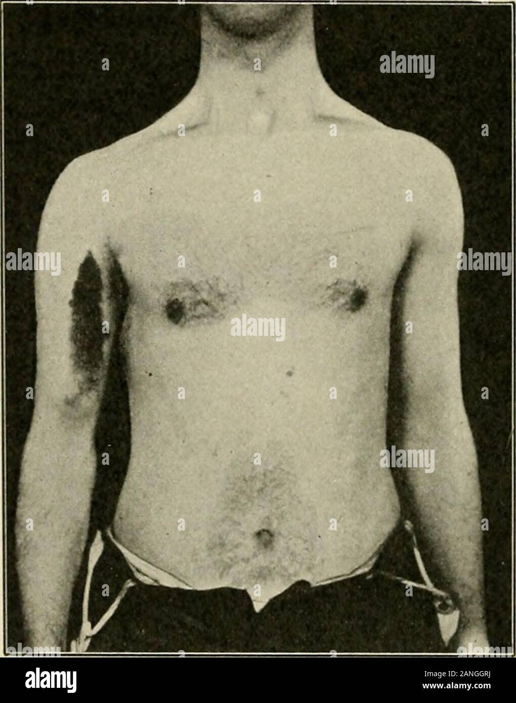 A text-book of first aid and emergency treatment . leg. Deformity.—The  shape of the limb is altered, partiallydue to the swelling and partly to  the break m the bone.When the bone is