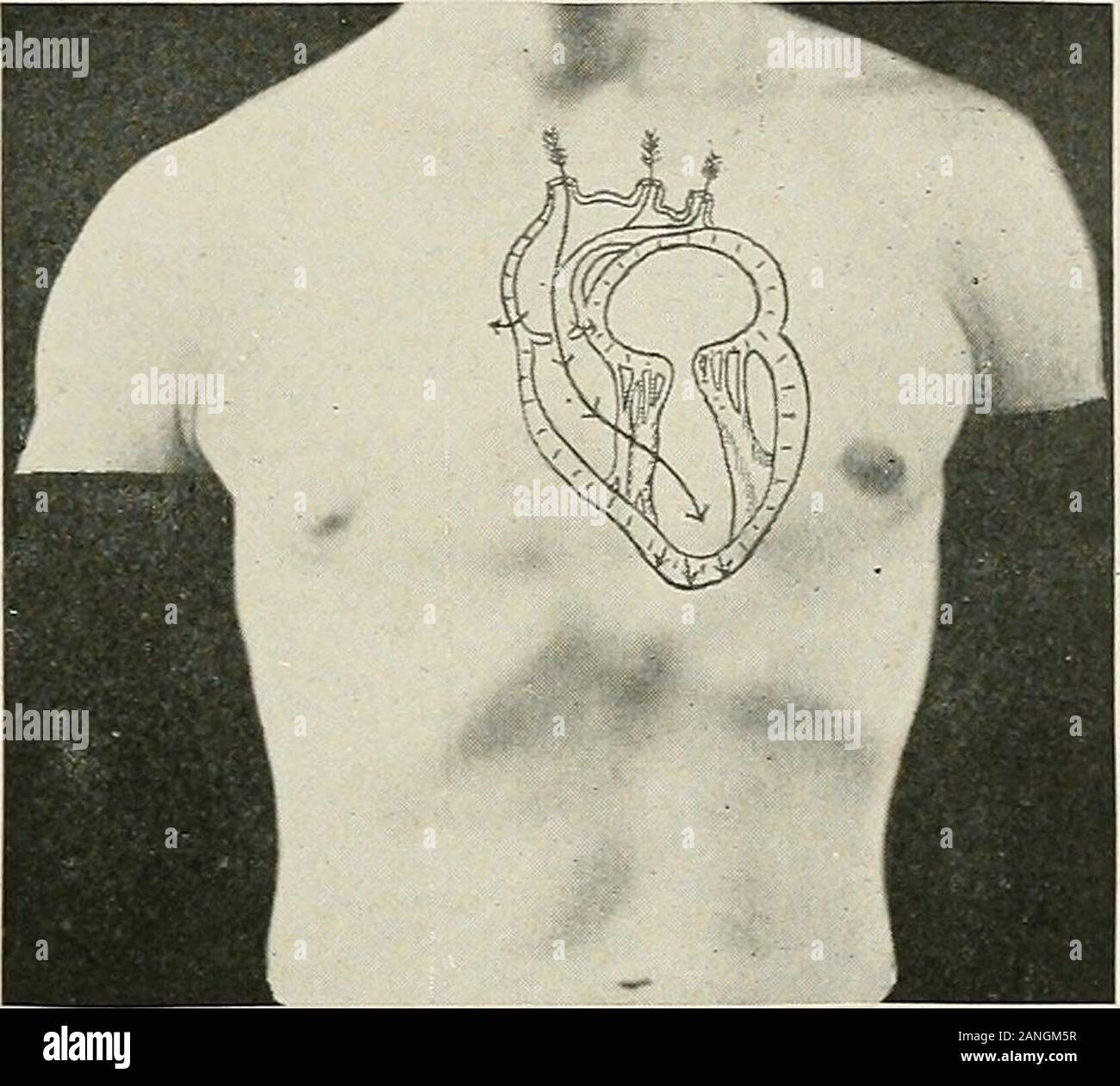 Cardiac murmur hi-res stock photography and images - Alamy