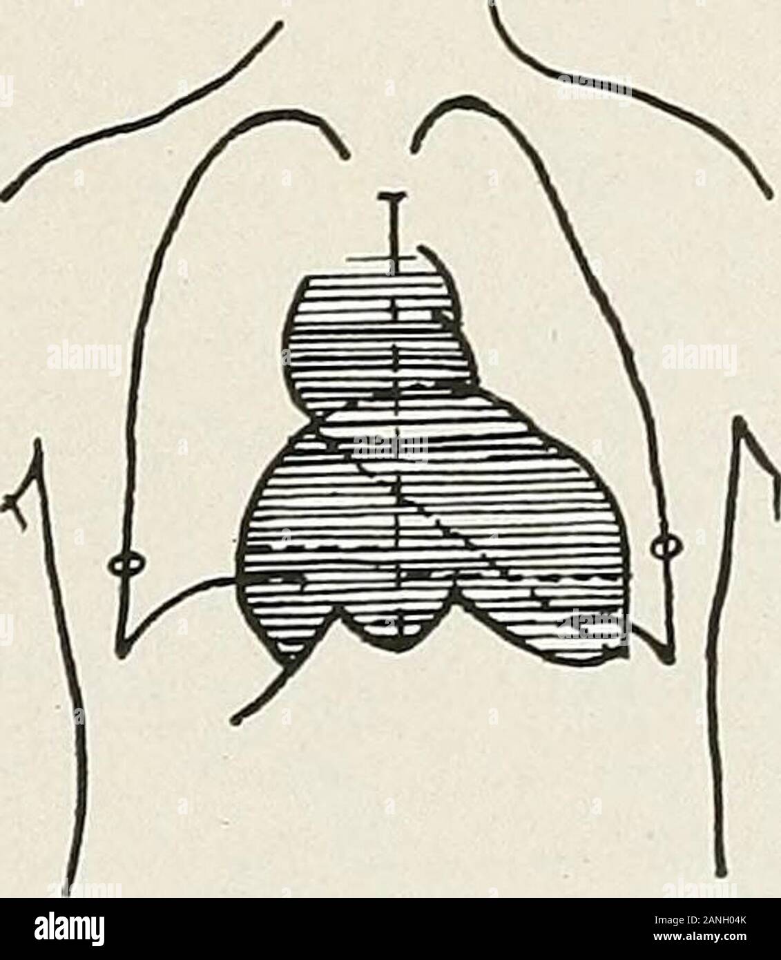 Tricular Diseases of the chest and the principles of physical diagnosis . Aortic ...