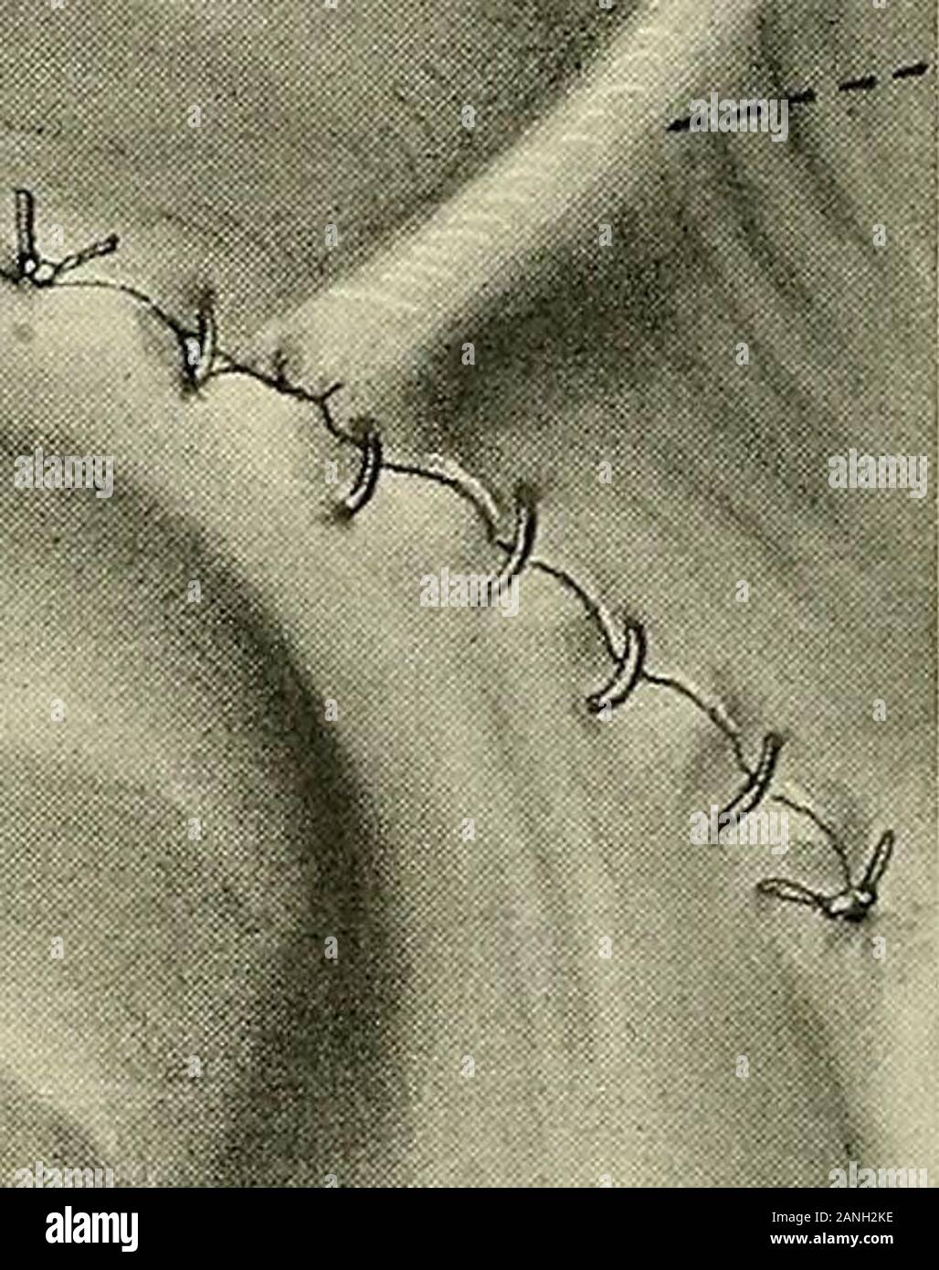 Gynecology . ( ^.e,cu>ocv,. Vv/.R&. Fig. 350.—Wertheims Operation for Cancer of the Cervix.Final